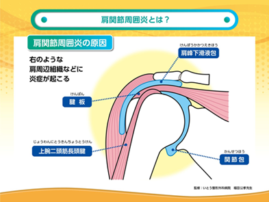 五十肩・四十肩① | 榎本メディカル(えのもと整骨院・鍼灸院)「深江橋駅」3分（大阪市・城東区）