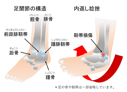 足関節捻挫 榎本メディカル えのもと整骨院 鍼灸院 深江橋駅 3分 大阪市 城東区